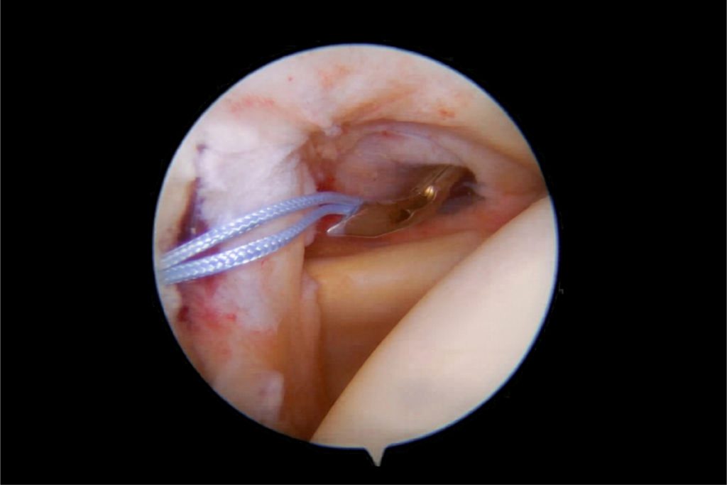 arthroscopy2